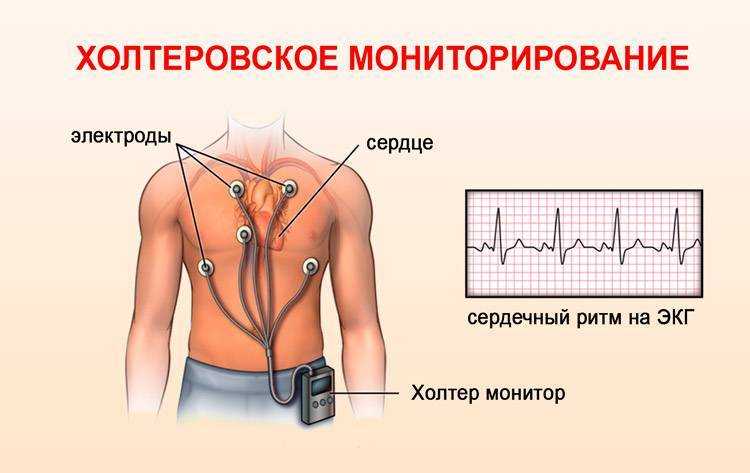Для чего назначают холтер на сердце - рекомендации кардиолога