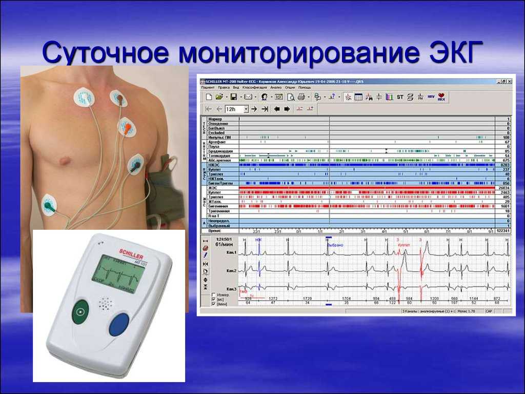 Холтеровское мониторирование сердца: подготовка, как проводится, правила для пациента